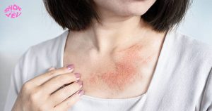 người bị dị ứng